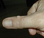 Wart on thumb